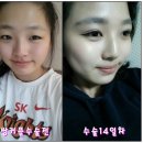 비씨아이성형외과 인형눈으로 만들어준♥