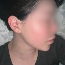 거의로 | 부산피부과 다운타임 짧은 피팅리프팅 통증 거의 없음 내돈내산 솔직후기