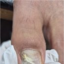 네일바이엘 - 수성구 상화로 102-2 | 경산 시지 발톱무좀 들뜨고 색변한 발톱 해결한 곳 네일바이엘