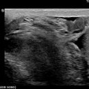 Rt inguinal hernia. 이미지