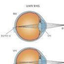 난시 뜻 난시 원인 증상 치료 난시 테스트 이미지