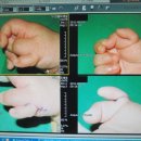 더블유(W)병원 오른손 엄지 무지 다지증 수술(2011.08.18~20) 마지막날 이미지