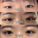 세미약국 - 대덕구 중리북로 41 | 쌍수 절개 세미 인아웃 안검하수 지방 제거 앞트임 붓기 기간 한달 내돈내산 후기