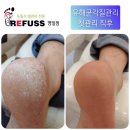 네일,꽃이피다&레푸스(명일점) | [악성각질][명일동각질관리][레푸스명일점] 유해균각질 관리