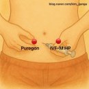 (연세아이소망여성의원) IVF-M HP + 오가루트란 주사 후기