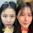 고랑 | 눈밑지방, 눈밑고랑 개선 | 리리핏 눈밑주사 내돈내산 후기