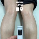마포-상암-마포-6327 | 종아리튼살 여러군데 업체 문의 후 선택은 스킨52마포