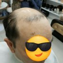 [창원가발 시원한가발 젊은가발] 양덕동 김호증모하이담헤어의 시술후기