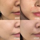 의료화장품 | 병원 입점 스킨부스터 엑소나 솔직 후기｜피부결·컨디션 변화 기록