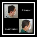 더스칼렛두피탈모센터