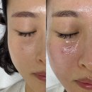[양주 피부관리] 루아에스테틱 더미스 리페어 필 솔직 후기! 피부 재생·모공·트러블 한 번에 관리...