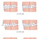 나 3급 부정교합인데 양악수술하는거 이미지