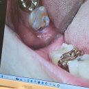 바른약속치과의원 | 부천역원데이차과 바른약속치과에서 느낀 세심한 진료 후기