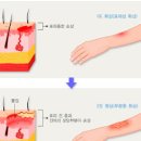 기름에 데였을때 1도화상 2도화상 치료 응급처지방법 이미지