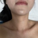 수도의원 | 편평사마귀 제거 후기 - 편평사마귀 제거 2주 후기 “강한미의원“