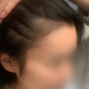 시지연합약국 | 원형 탈모 증상 관리 여성 정수리탈모 자가진단 탈모완화 제품추천