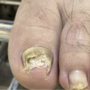 더골든네일 | 배곧발톱무좀 10년 넘은 두꺼운발톱 해결한 후기 네일포유 골든풋 배곧점