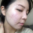 쁨샵 스킨앤브로우 답십리피부샵 여드름 관리 후기