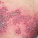 대상포진 1년 이미지