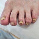비엔올샵 | 군산 소룡동 발톱무좀 만족도 최고였어요 골든풋 군산점 비엔네일