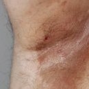 설성약국 | [당뇨 환자 필독] 사타구니·발가락 사이 질환, 무좀일까 홍색 음선일까?