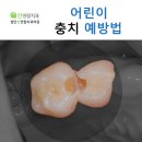 발안선연합치과의원 네이버블로그