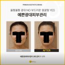 옆 얼굴 여백 옆광대 축소 위뷰티 가격 평촌 피부관리 솔직후기