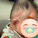 [한헬스케어 하니헬멧]단두증 사두증 두상 교정 헬멧-두상 교정 후기(3)