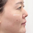 골드피부관리 | 여드름 피부관리 골드PTT 1회 후기 압출 통증 솔직 리뷰