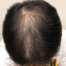 모프로의원 | 모프로의원 비절개 3978모 6개월차 경과체크 후기 (사진 많음 주의)