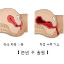 분만 후 출혈[Postpartum hemorrhage] 여성질환 이미지