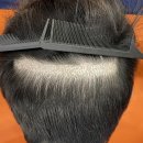 부산 맘모스헤어라인의원 | 부산 맘모스헤어라인의원에서 시행한 모발이식 재수술에 대한 기록과 고찰