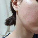 좁쌀여드름,지루성피부염 - 내돈내산 황현주스킨케어,기비코스메틱 후기