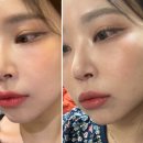 윈메디칼 | 신논현피부과 자연스러운입술필러 입꼬리보톡스 효과 통증 후기 총정리