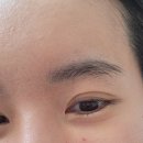 라디앙의원 | [눈밑조각주사 후기] 구리 라디앙의원 1회차 시술 &amp; 1주일 경과 리얼 후기!