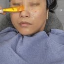 의정부피부과 미글로우 리프팅 솔직 후기