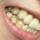 예쁜턱치과기공소 | [은평구 교정/내돈내산]인비절라인 치아교정 마무리 후기(스압주의)