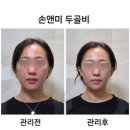 [대전 탄방동] 윤곽 비대칭 관리 &#34;손앤미뷰티스킨&#34; 두골비 후기