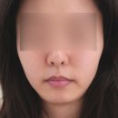 수정위례-A-10 | 위례피부관리, 더작위례점 얼굴 조형 윤곽관리 후기