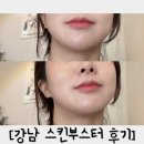 강남역피부과 첫스킨부스터 물광주사 전후후기