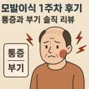 부기1 | 모발이식 1주차 후기 – 통증과 부기 솔직 리뷰