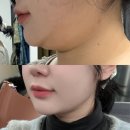 오렌지라인 | 이중턱 람스 가격 얼굴지방분해주사 오렌지케어까지! V라인 된 후기