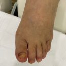 바미네일레푸스용인 | 충주 발관리 추천 바미네일 레푸스 충주연수점 내성발톱 케어 솔직후기