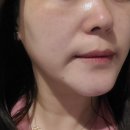 이메디컬 | 수원 인계동 메디컬오, 하이푸 레이저 1회차 내돈내산 후기
