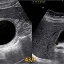 급성 결석담낭염 Acute calculous cholecystitis 이미지