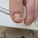 영종이엠365의원 | 기흥 내성발톱 무좀 치료 광교이엠365의원 꼼꼼한 관리 후기
