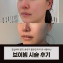 브이빔 잠실새내역피부과 내돈내산 붉은기 홍조 치료 후기