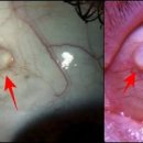 결막낭종 , 눈 이물감 &amp; 눈물집 이미지