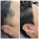 블랭크smp | [ 블랭크 유 ] 두피문신 ,SMP 탈모 커버