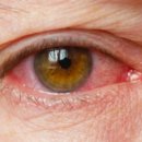 눈에 염증 이미지